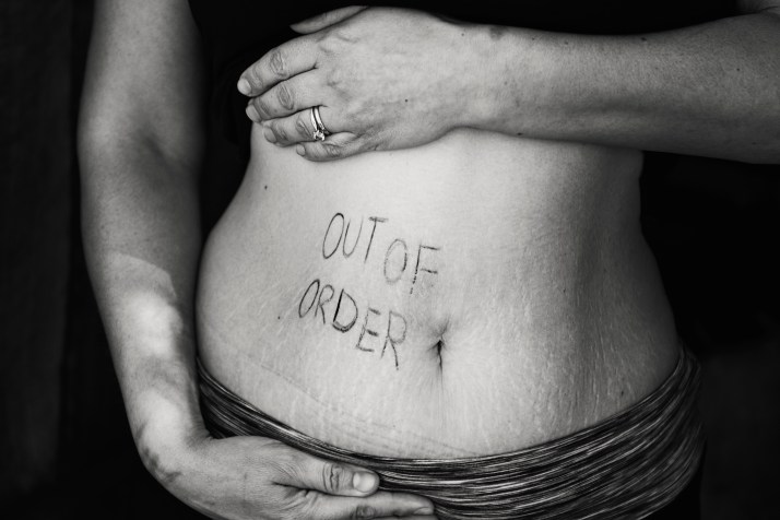 Stretch marks, Beauty, Body Image